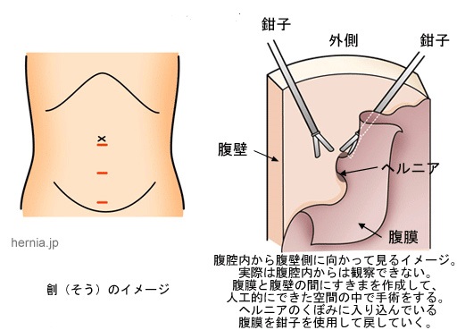 hernia-surgery_img02