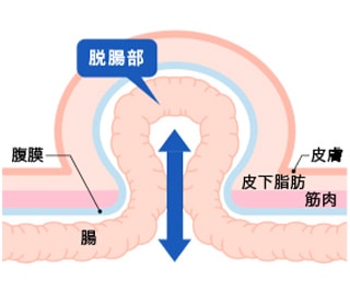 鼠径ヘルニアについて