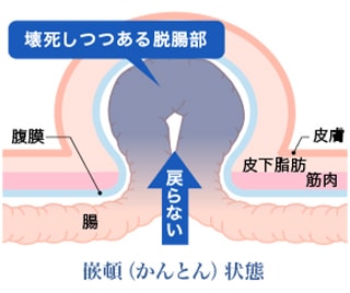 注意すべき『嵌頓(かんとん)』とは
