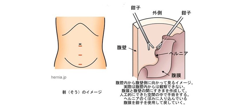 TEP法(腹腔鏡を用いた腹膜前到達法)