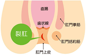 切れ痔について