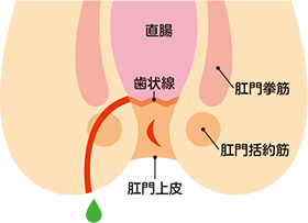 痔ろう