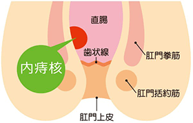 いぼ痔（痔核）