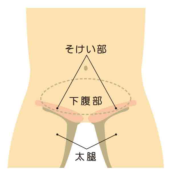 鼠径（そけい）ヘルニア