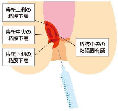 ジオン注射（ALTA療法）のイラスト