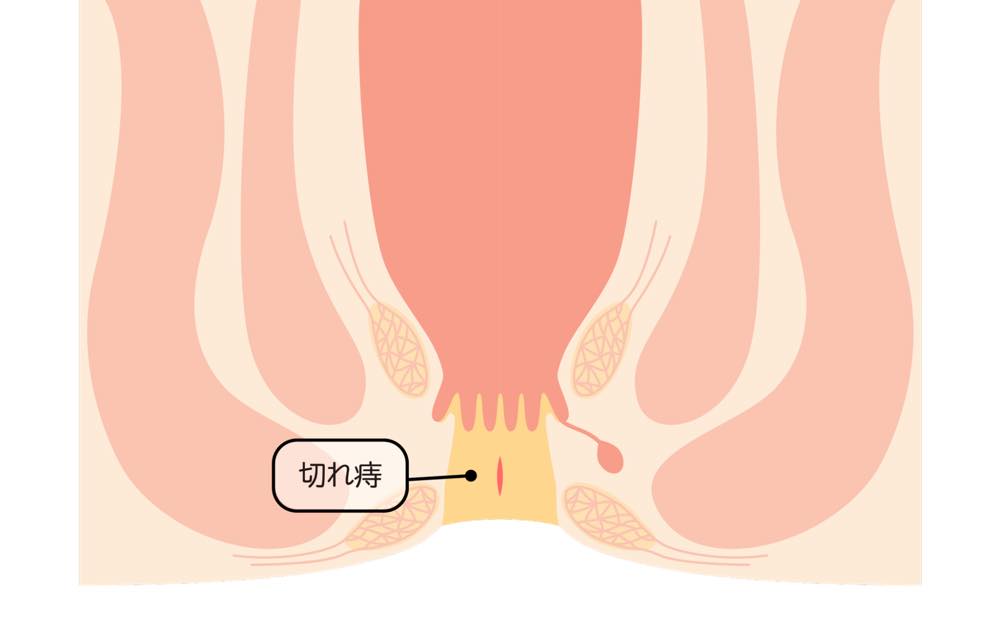 切れ痔