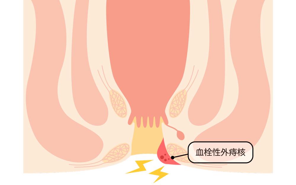 血栓性外痔核