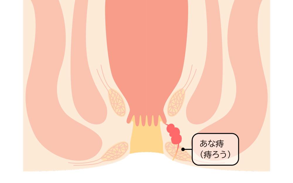 痔瘻（あな痔）